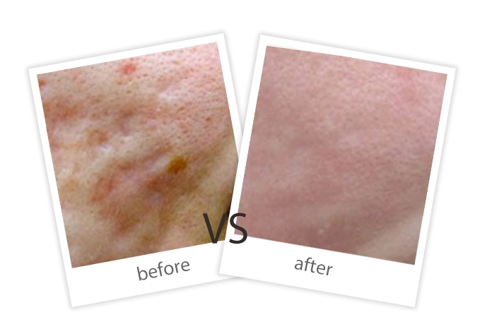 Acne Scar-7