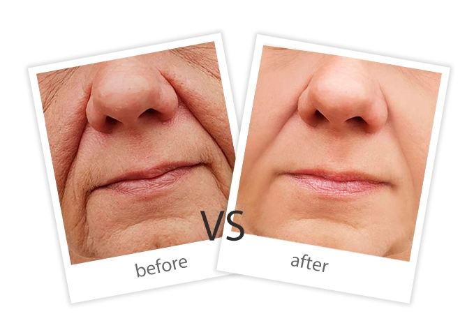 AIRPRITI-Treatment-Facial Treatment-10