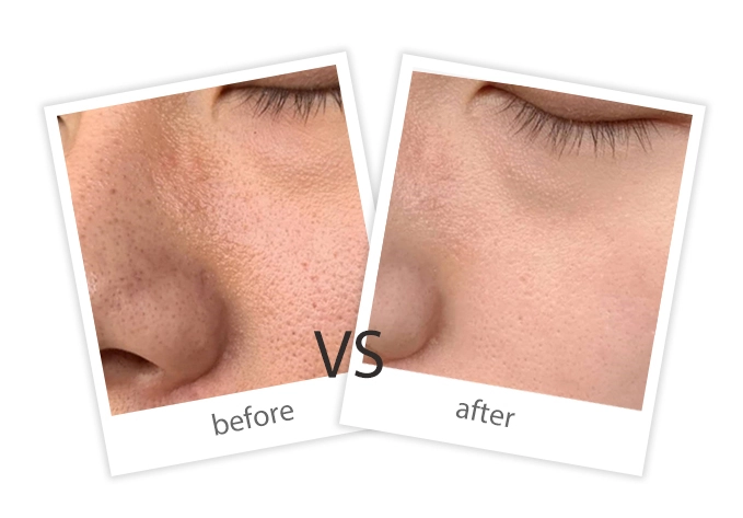 AIRPRITI-Treatment-Facial Treatment-13