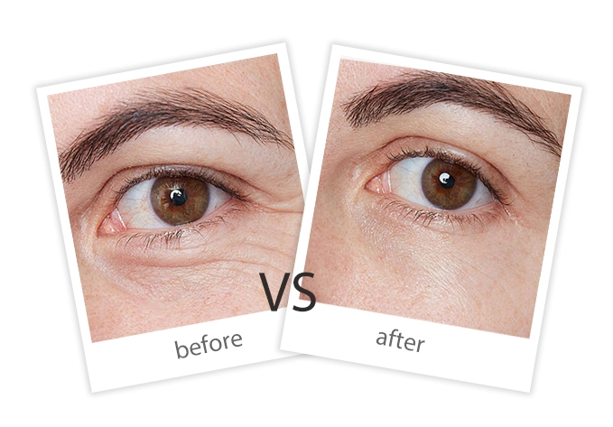 AIRPRITI-Treatment-Facial Treatment-7