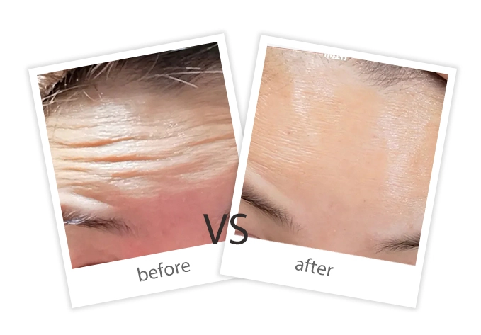 AIRPRITI-Treatment-Facial Treatment-8