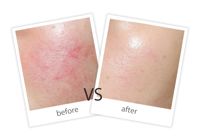 AIRPRITI-Treatment-Facial Treatment-9