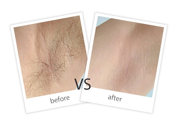 AIRPRITI-Treatment-Hair Removal-10