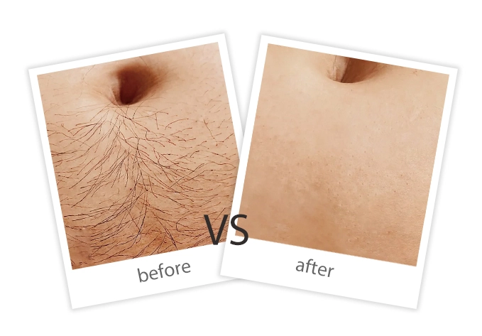 AIRPRITI-Treatment-Hair Removal-5