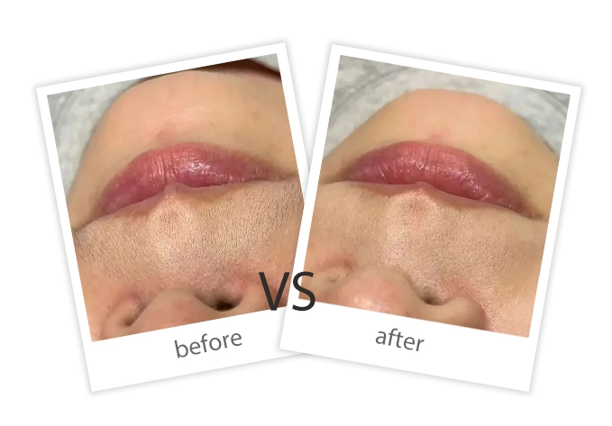 AIRPRITI-Treatment-Hair Removal-6