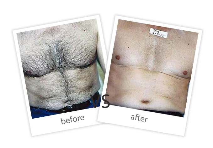 AIRPRITI-Treatment-Hair Removal-7