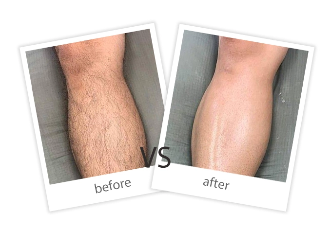 AIRPRITI-Treatment-Hair Removal-8