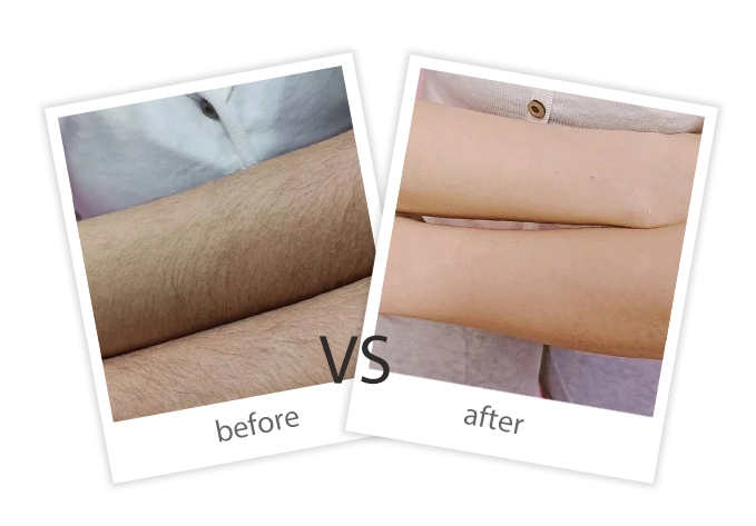 AIRPRITI-Treatment-Hair Removal-9