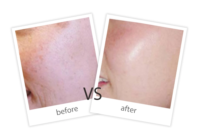 AIRPRITI-Treatment-Pigment Removal-5