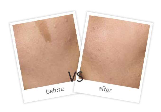 AIRPRITI-Treatment-Pigment Removal-6