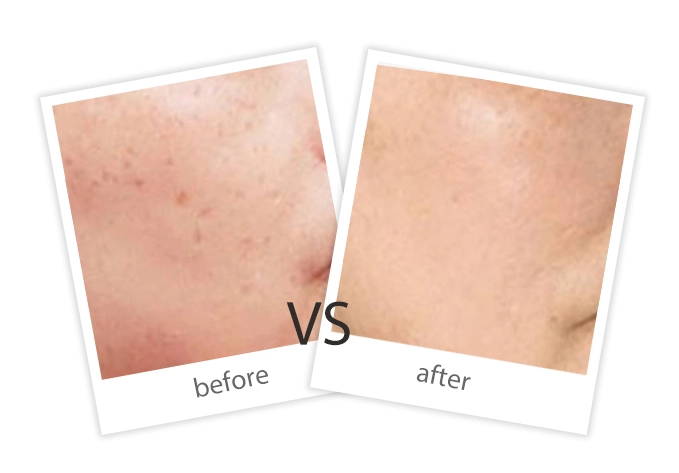 AIRPRITI-Treatment-Pigment Removal-7