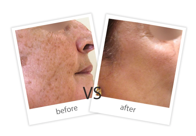 AIRPRITI-Treatment-Pigment Removal-8