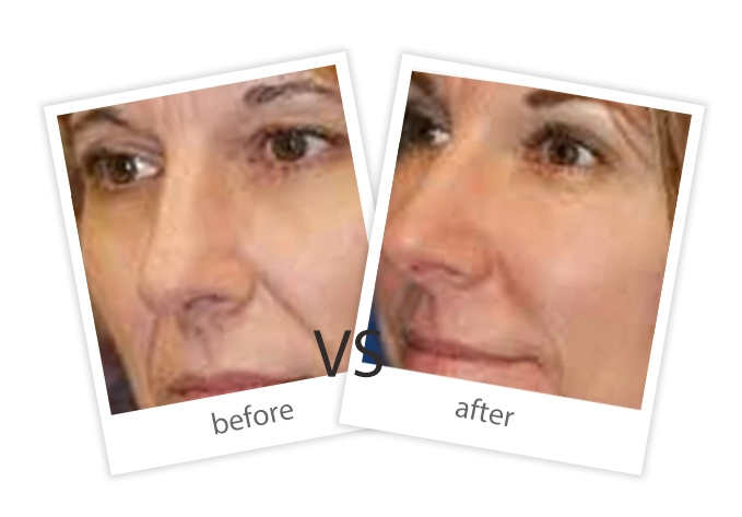 AIRPRITI-Treatment-Tattoo Removal-5