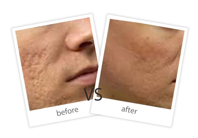 AIRPRITI-Treatment-Tattoo Removal-6