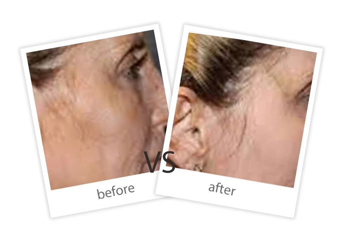 AIRPRITI-Treatment-Tattoo Removal-7