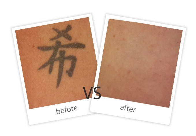 FEIYU-Treatment-Tattoo Removal-5