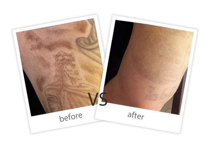 FEIYU-Treatment-Tattoo Removal-6