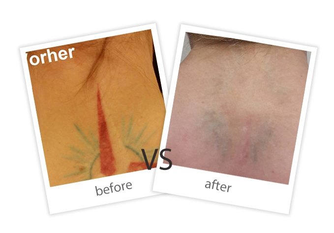 FEIYU-Treatment-Tattoo Removal-7