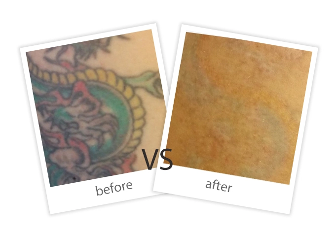 FEIYU-Treatment-Tattoo Removal-8