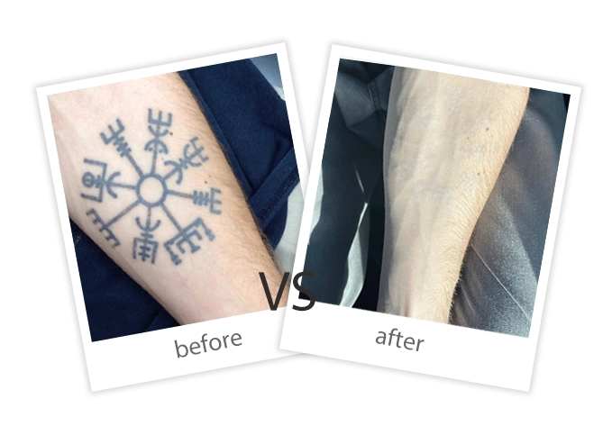 FEIYU-Treatment-Tattoo Removal-9