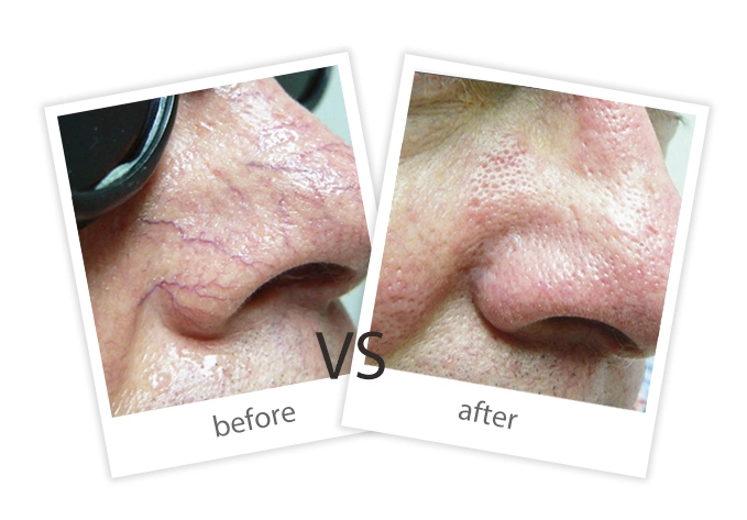 AIRPRITI-Treatment-Vascular Lesions-4