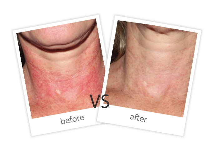 AIRPRITI-Treatment-Vascular Lesions-6