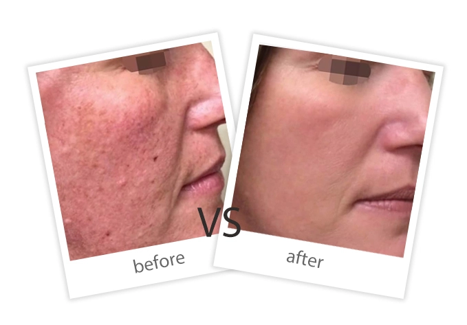 AIRPRITI-Treatment-Vascular Lesions-7