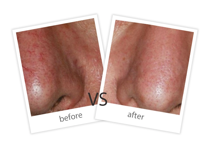 AIRPRITI-Treatment-Vascular Lesions-8