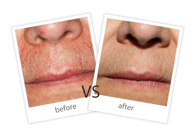 AIRPRITI-Treatment-Vascular Lesions-9