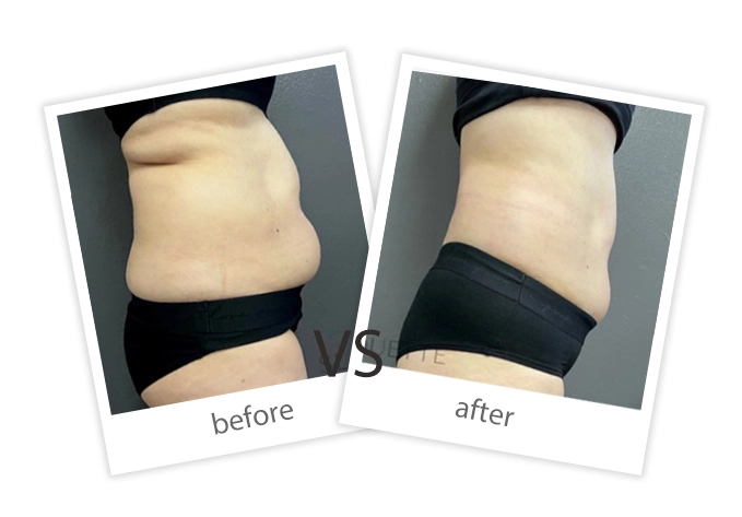 AIRPRITI-Treatment-Weight Loss & Build Muscle-11