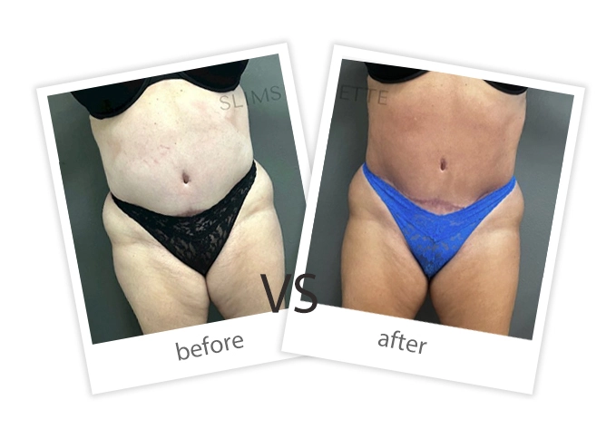 AIRPRITI-Treatment-Weight Loss & Build Muscle-12