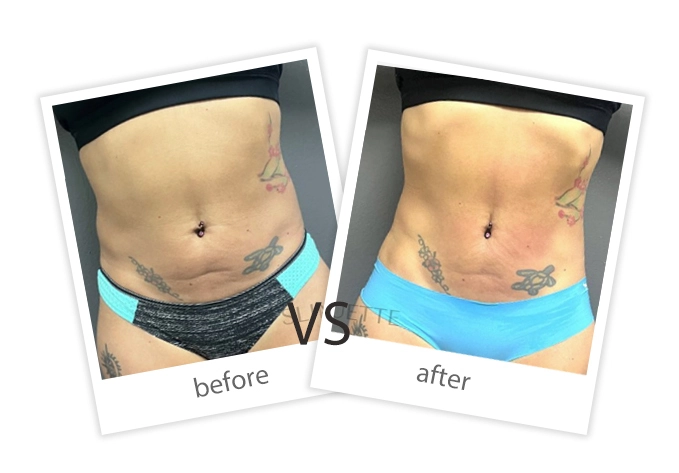 AIRPRITI-Treatment-Weight Loss & Build Muscle-13