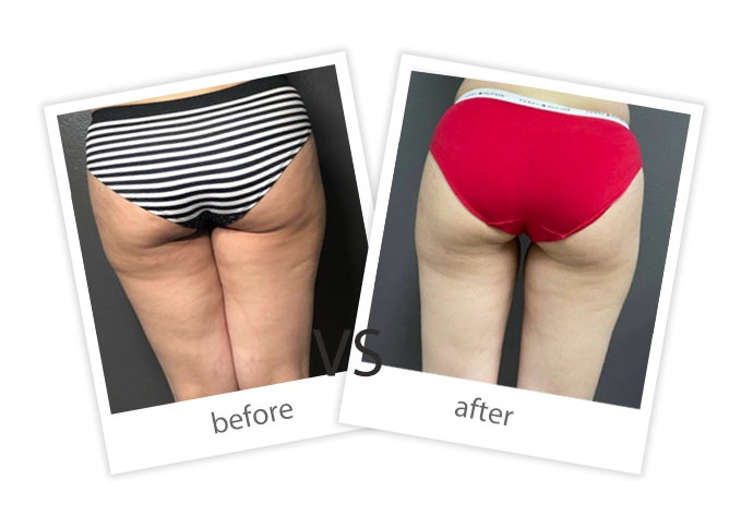 AIRPRITI-Treatment-Weight Loss & Build Muscle-15