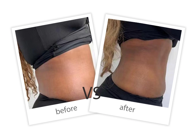 AIRPRITI-Treatment-Weight Loss & Build Muscle-21